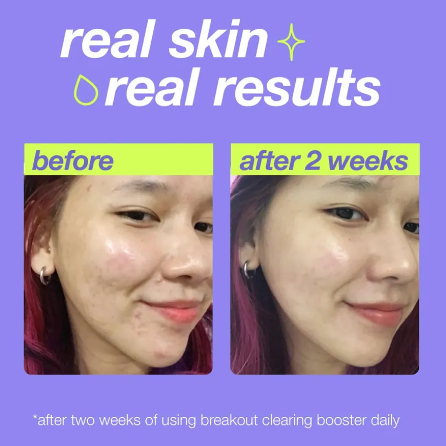 Clear Start Breakout Clearing Booster 30ml